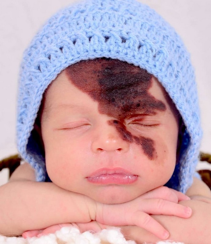 #4 |  Una mujer se pinta una réplica de la marca de nacimiento de su hijo en la cara para celebrar su singularidad.  Zestradar