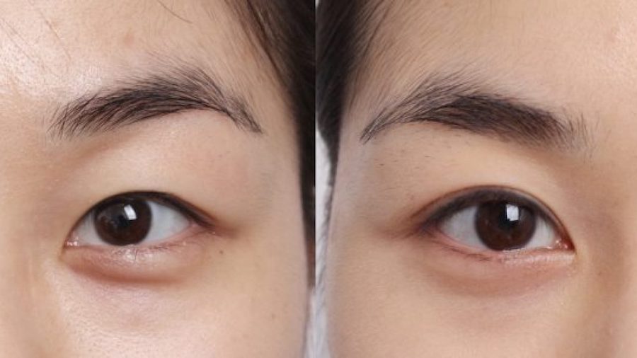 Blefaroplastia |:  7 procedimientos quirúrgicos populares en Corea del Sur |  Zestaradar